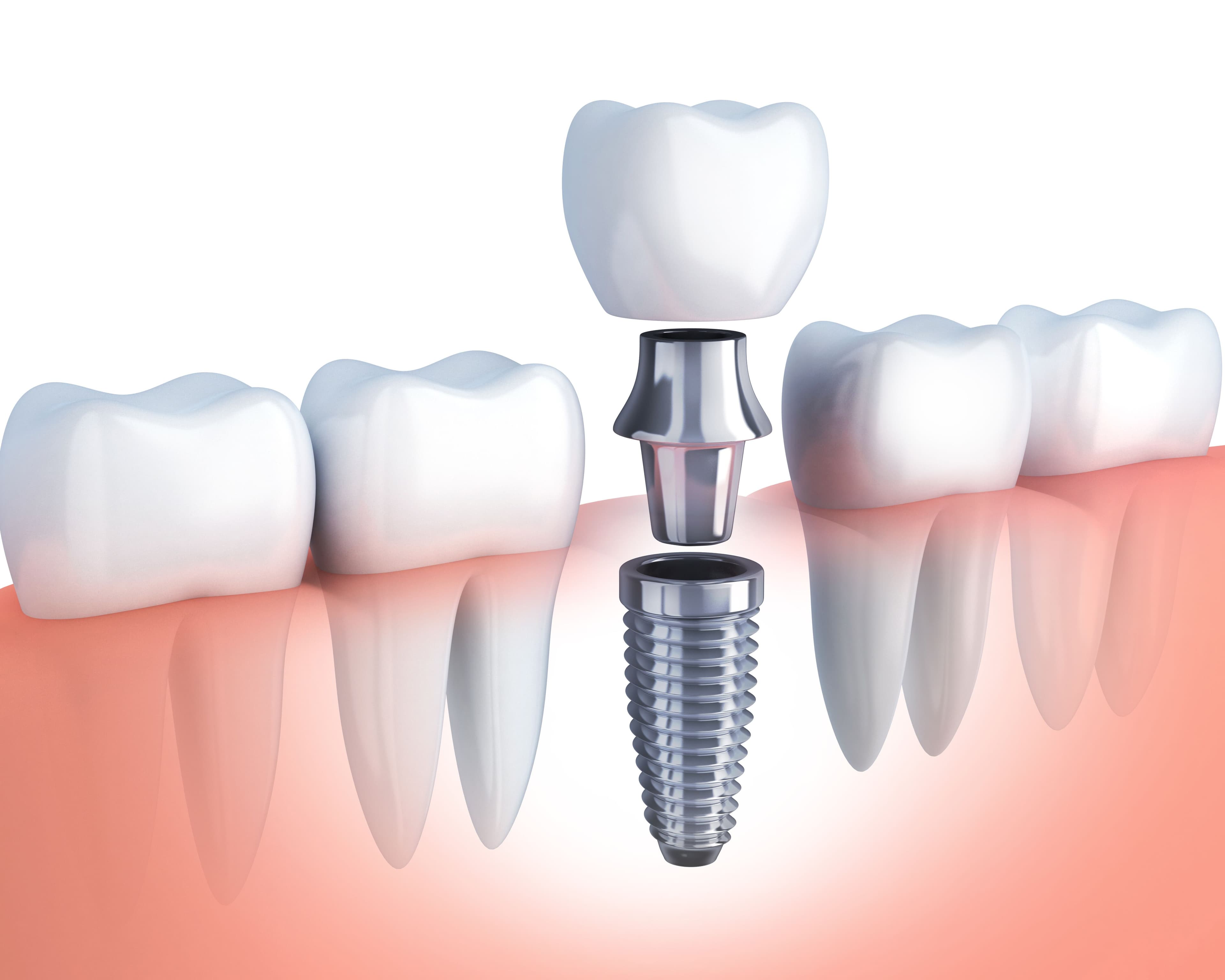 Advanced Implantology Masterclass